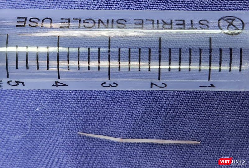 Chiếc xương cá dài 2,5cm được lấy từ sàn miệng bệnh nhân