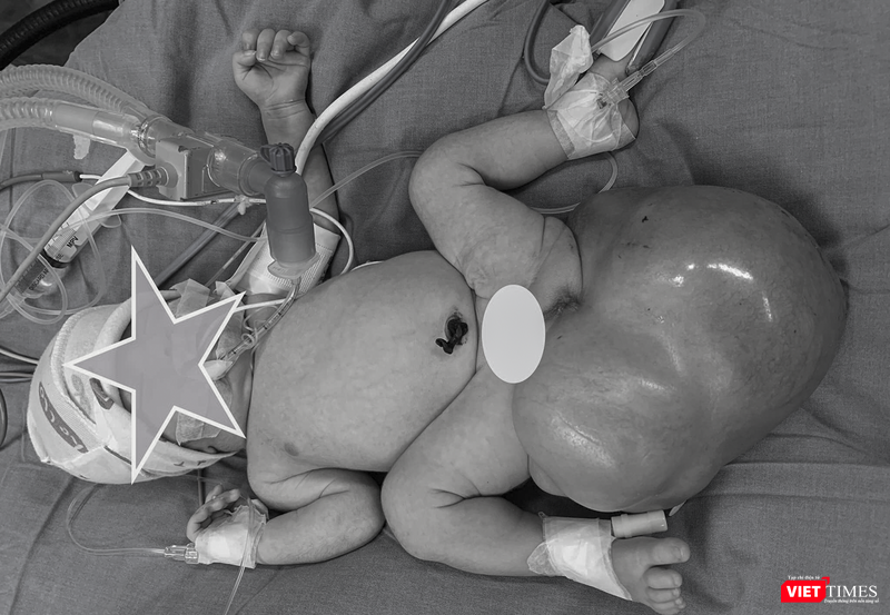 Bé gái 5 ngày tuổi mắc khối u nặng hơn 1,2kg được phát hiện từ trong bào thai mẹ. (Ảnh BVCC)
