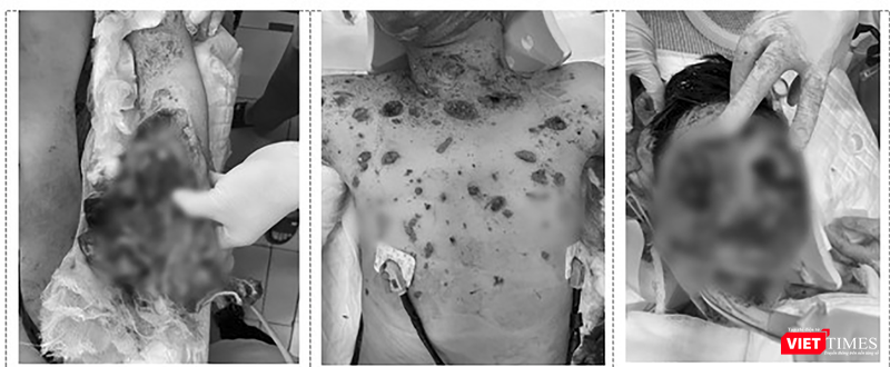 Nạn nhân bị đa chấn thương sau vụ nổ laptop (Ảnh BVCC)