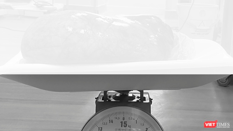 Khối u nang buồng trứng nặng 8,1kg được lấy ra từ cơ thể bà cụ 83 tuổi