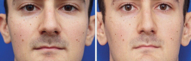 Chụp ảnh tự sướng nhiều sẽ làm mũi bị to ra? ảnh 1