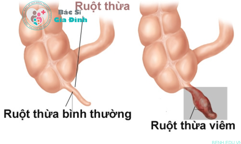 (ảnh minh họa: benh.edu.vn)