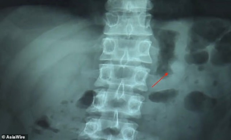 phim chụp X-quang cho thấy một bên tai nghe AirPods nằm trong cơ thể (ảnh: Asia Wire)