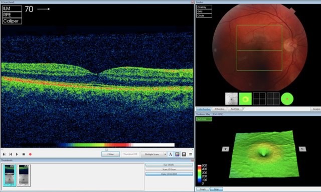 AI của DeepMind đang phân tích hình ảnh quét OCT (Ảnh DeepMind).