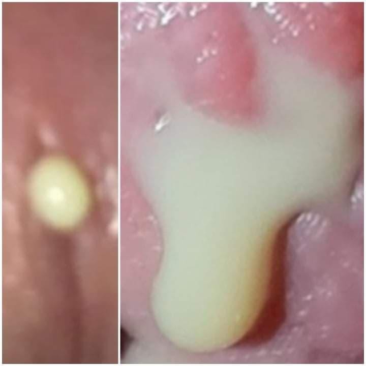 Hình ảnh mủ niệu đạo do lậu gây ra