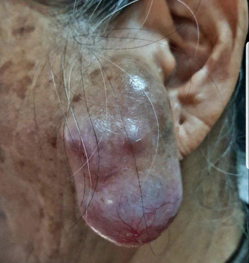 Những khối u kỳ lạ được chữa trị tại bệnh viện 175