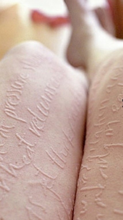 Da vẽ nổi còn được gọi là da viết chữ, không ảnh hưởng đến tính mạng nhưng rất dễ trở thành mãn tính (ảnh minh họa)