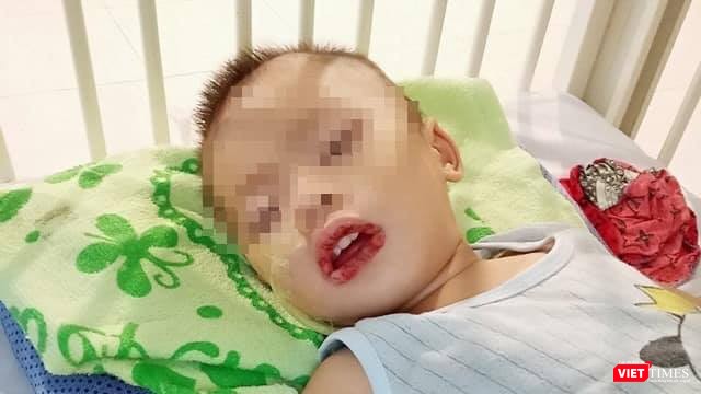 Dùng thuốc cam đánh tưa lưỡi cho con, trẻ bị ngộ độc chì, tổn thương não, hôn mê ảnh 2 Uống nhầm thuốc tẩy bồn cầu, bé trai gặp hậu quả nghiêm trọng