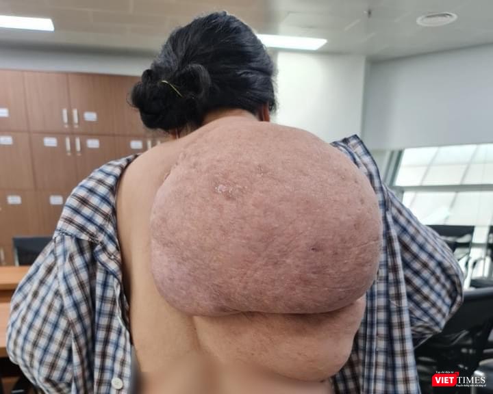 Nỗi khổ của người phụ nữ phải chung sống với khối u khổng lồ (Ảnh: BVCC)