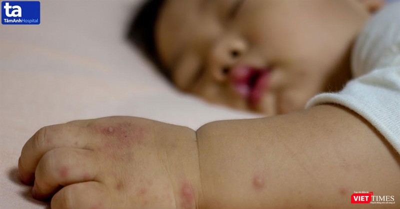 Bệnh tay chân miệng có nhiều biến chứng nguy hiểm. Ảnh: Bệnh viện Đa khoa Tâm Anh