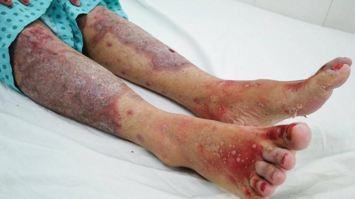Dấu hiệu hoại tử thượng bì nhiễm độc nặng trên đôi chân người bệnh Dấu hiệu hoại tử thượng bì nhiễm độc nặng trên đôi chân người bệnh