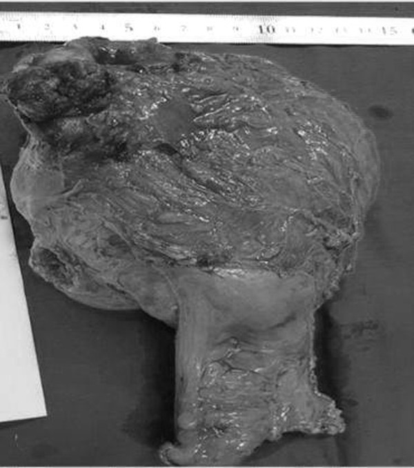 Khối u lớn cắt ra từ trực tràng của bệnh nhân