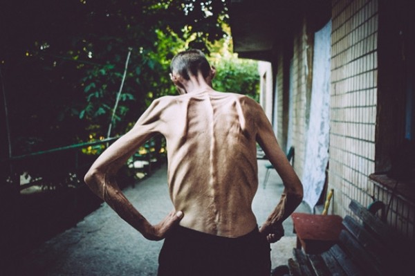 Bệnh nhân mắc bệnh lao phổi (Ảnh: Báo Lao động) Bệnh nhân mắc bệnh lao phổi (Ảnh: Báo Lao động)