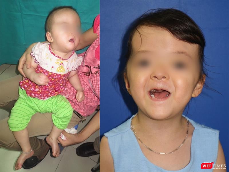 Bé N.T.T. (6 tuổi) trước và sau khi phẫu thuật tạo hình vùng mặt Bé N.T.T. (6 tuổi) trước và sau khi phẫu thuật tạo hình vùng mặt