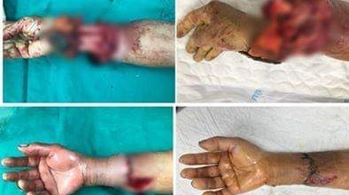 Cánh tay của bệnh nhân trước và sau khi được ghép nối.