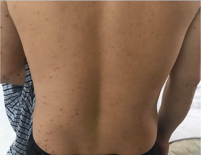 Khi mắc u vàng phát ban, các nốt sần sẽ xuất hiện khắp cơ thể kèm theo bệnh lý đái tháo đường