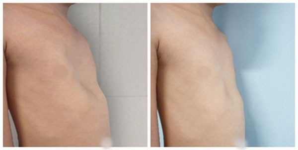 Xương ức của bệnh nhi được cải thiện rõ rệt sau khi điều trị bằng phương pháp mới