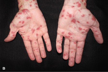 Bàn tay của một người mắc bệnh giang mai