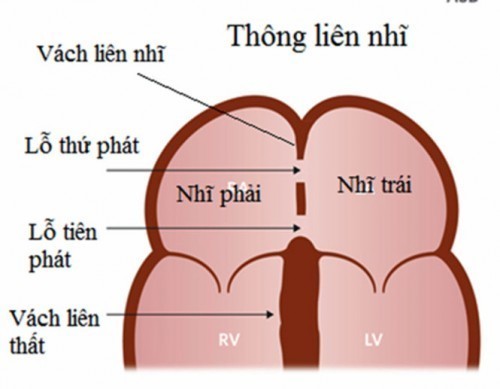 Hình minh họa bệnh thông liên nhĩ ở trẻ