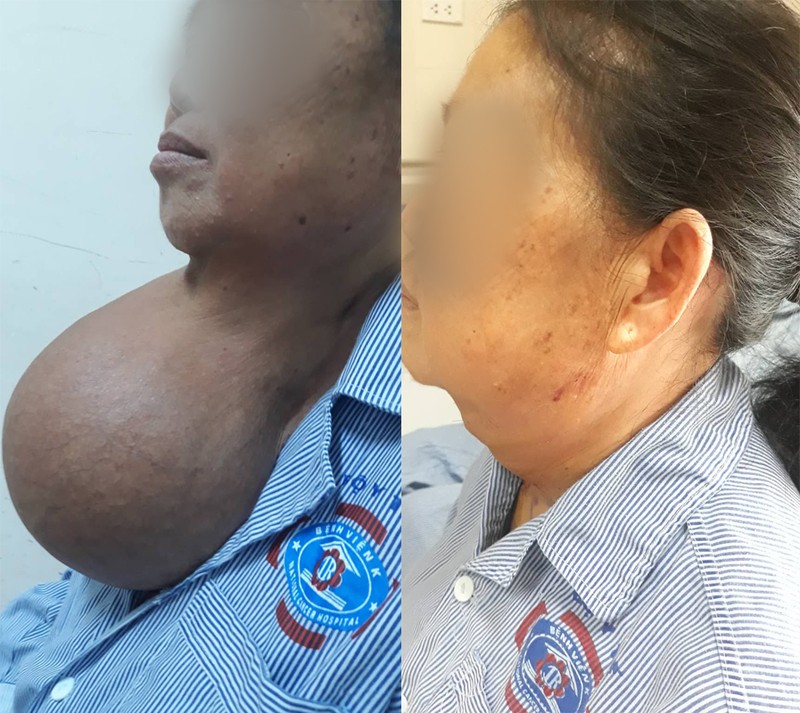 Vùng cổ của bà V. trước và sau khi mổ