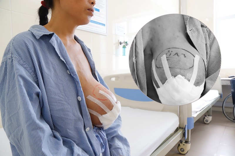 Khối u khiến ngực trái của chị C. sưng to