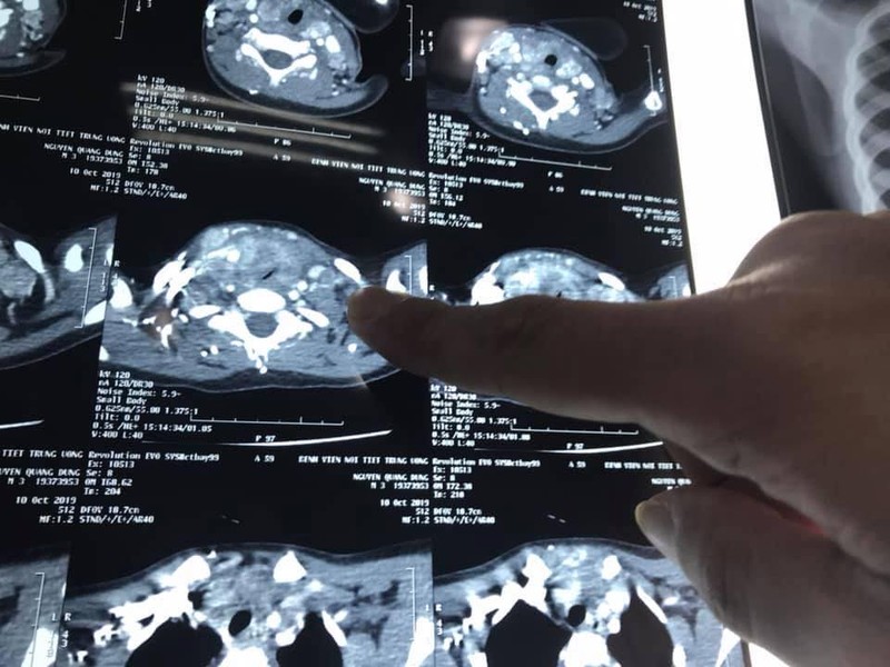 Ảnh chụp CT khối u của bé D. Ảnh chụp CT khối u của bé D.