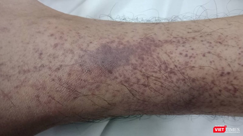 Tình trạng xuất huyết nặng dươi da của một bệnh nhân mắc sốt xuất huyết trên nền bệnh tan máu bẩm sinh -Thalassemia - tại Bệnh viện Bạch Mai.