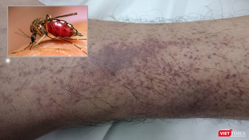 Cảnh giác với căn bệnh chưa có vaccine vào đỉnh dịch trong tháng 11