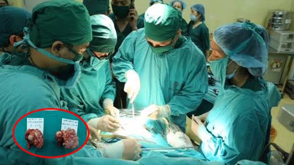 Các bác sĩ phẫu thuật loại bỏ 2 khối u hình giống chiếc xúp lơ có trọng lượng 1,6 kg và 2 kg của các bệnh nhân T. và V.