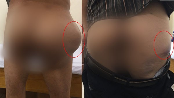 Khối u kích thước lớn khiến cho các bệnh nhân bị biến dạng cơ thể