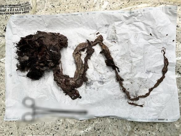 Một búi tóc dài được các bác sĩ Bệnh viện Nhi đồng Thành phố (TP.HCM) lấy ra khỏi ruột một nữ bệnh nhi - Ảnh: Bệnh viện cung cấp