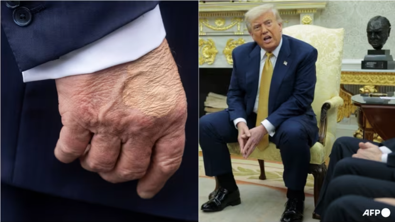 Bàn tay phải của Tổng thống Mỹ Donald Trump được nhìn thấy khi ông phát biểu với báo chí trước khi lên trực thăng vào ngày 15/7 và Tổng thống trong một cuộc họp tại Phòng Bầu dục của Nhà Trắng vào ngày 16/7. Ảnh: AFP.