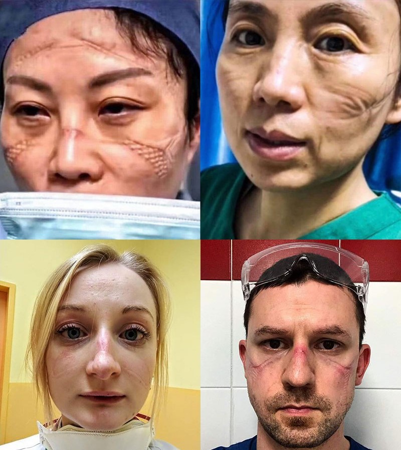 Khuôn mặt sưng đỏ, in vết hằn khẩu trang của đội ngũ y bác sỹ tuyến đầu các nước trong trận chiến chống dịch Covid-19. Do làm việc với cường độ cao và không có thời gian nghỉ ngơi khiến sức khỏe và sự đề kháng yếu đi, các bác sỹ, y tá là những người dễ gặp nguy hiểm nhất nếu bị lây nhiễm virus. Khuôn mặt sưng đỏ, in vết hằn khẩu trang của đội ngũ y bác sỹ tuyến đầu các nước trong trận chiến chống dịch Covid-19. Do làm việc với cường độ cao và không có thời gian nghỉ ngơi khiến sức khỏe và sự đề kháng yếu đi, các bác sỹ, y tá là những người dễ gặp nguy hiểm nhất nếu bị lây nhiễm virus.