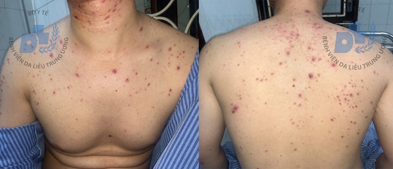 Sau hơn 1 tháng sử dụng thuốc nam, bệnh nhân xuất hiện thêm nhiều tổn thương sẩn mụn mủ kích thước đồng đều, rải rác vùng thân mình, cánh tay 2 bên. Sau hơn 1 tháng sử dụng thuốc nam, bệnh nhân xuất hiện thêm nhiều tổn thương sẩn mụn mủ kích thước đồng đều, rải rác vùng thân mình, cánh tay 2 bên.