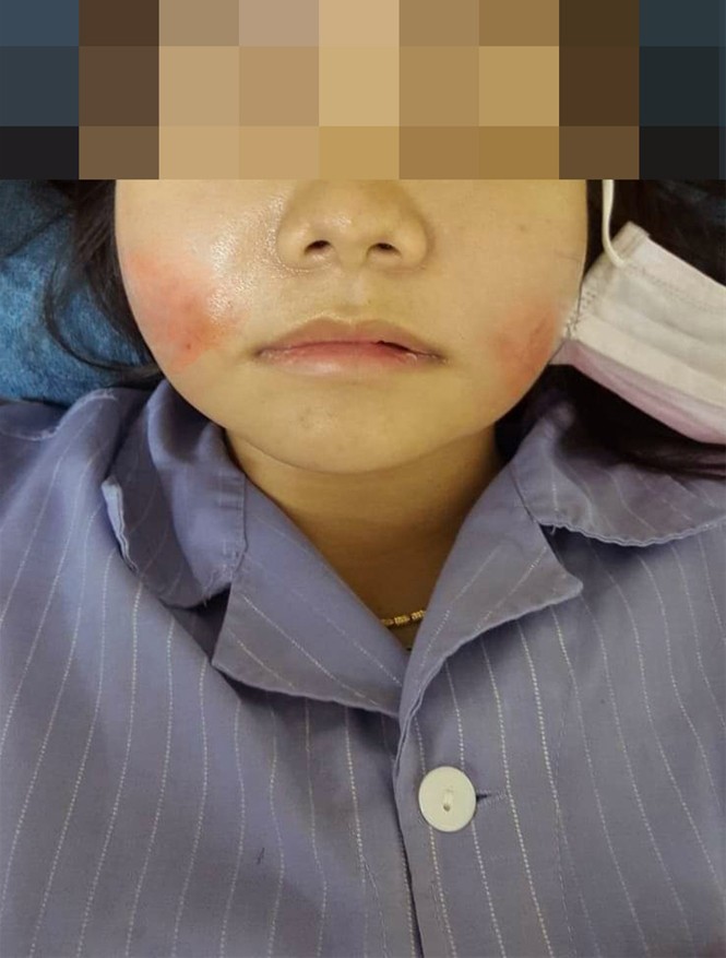 Hai má sưng vù vì làm đẹp bằng Filler