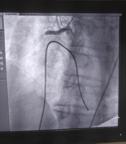 Hình ảnh huyết khối gây tắc cụt động mạch vành phải từ đoạn I. Ảnh: Bệnh viện Đa khoa Đức Giang