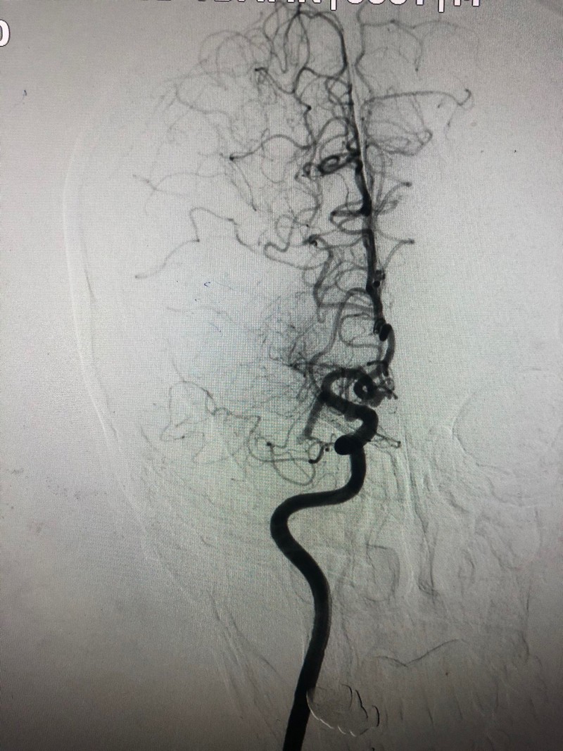 Chụp tắc động mạch não giữa đoạn M1 phải. Ảnh: BVCC