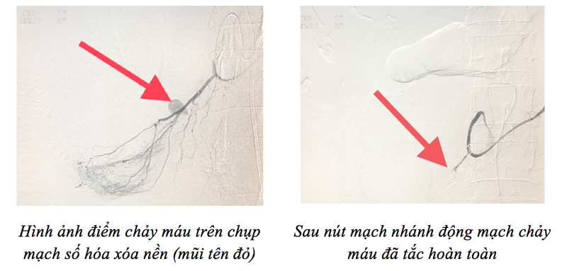 Bác sĩ áp dụng kỹ thuật nút mạch để cứu sống bệnh nhân. Ảnh: BVCC
