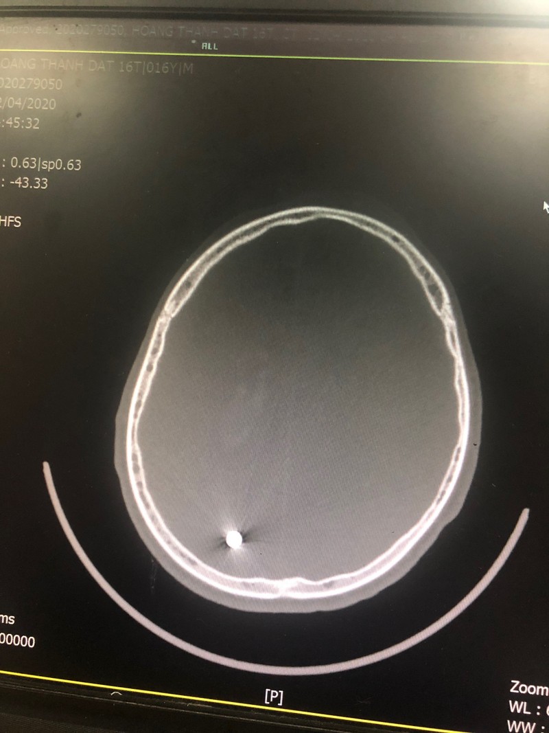 Phim chụp vết thương viên đạn xuyên qua não của bệnh nhân Đ. Ảnh: BVCC