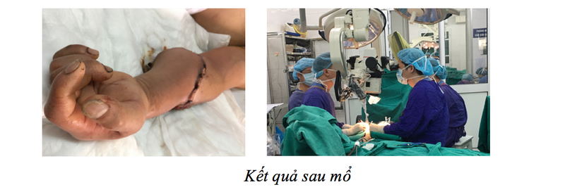 Cánh tay của bệnh nhân sau mổ. Ảnh: BVCC
