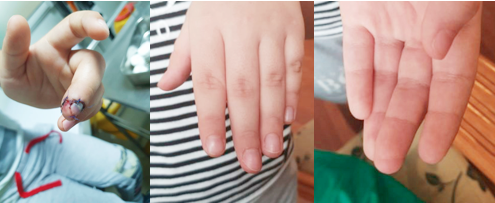 Ngón tay của bệnh nhi đã có lại cảm giác, vận động sinh hoạt bình thường. Ảnh: BVCC Ngón tay của bệnh nhi đã có lại cảm giác, vận động sinh hoạt bình thường. Ảnh: BVCC