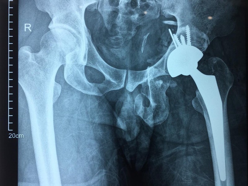 Phim chụp X-quang của bệnh nhân sau phẫu thuật thay khớp háng. Ảnh: Bệnh viện Hữu nghị Việt Đức Phim chụp X-quang của bệnh nhân sau phẫu thuật thay khớp háng. Ảnh: Bệnh viện Hữu nghị Việt Đức