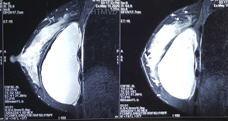 Hình ảnh túi ngực của bệnh nhân (Ảnh: Bệnh viện Hữu nghị Việt Đức) Hình ảnh túi ngực của bệnh nhân (Ảnh: Bệnh viện Hữu nghị Việt Đức)