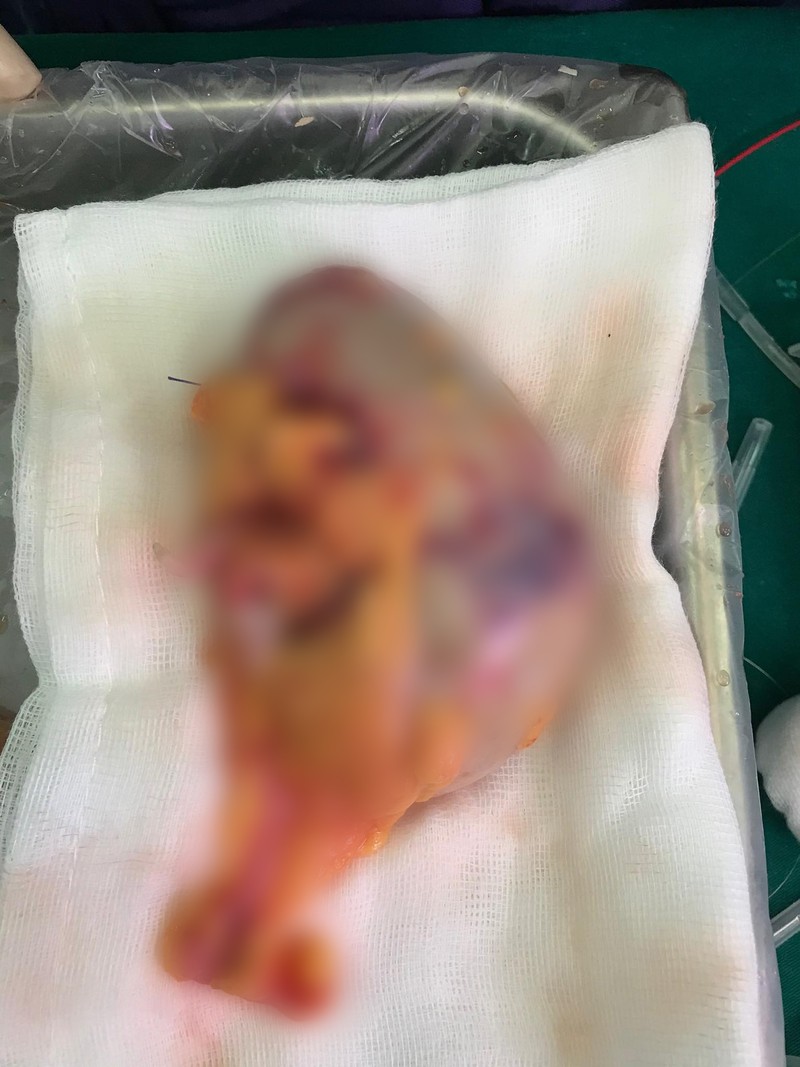 Quả thận trái của bệnh nhân được làm sạch trước khi ghép (Ảnh: Bệnh viện Hữu nghị Việt Đức) Quả thận trái của bệnh nhân được làm sạch trước khi ghép (Ảnh: Bệnh viện Hữu nghị Việt Đức)