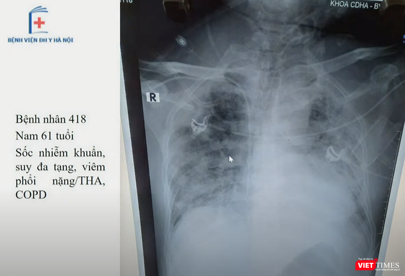 Hình ảnh X-quang phổi của 1 bệnh nhân mắc COVID-19 (Ảnh: Bệnh viện Đại học Y Hà Nội)