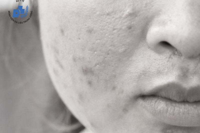 Sau điều trị, mụn trứng cá vẫn có thể tái phát (Ảnh: Bệnh viện Da liễu Trung ương)