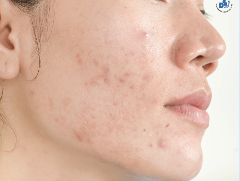 Mụn trứng cá là nỗi sợ của nhiều chị em phụ nữ (Ảnh: Bệnh viện Da liễu Trung ương)