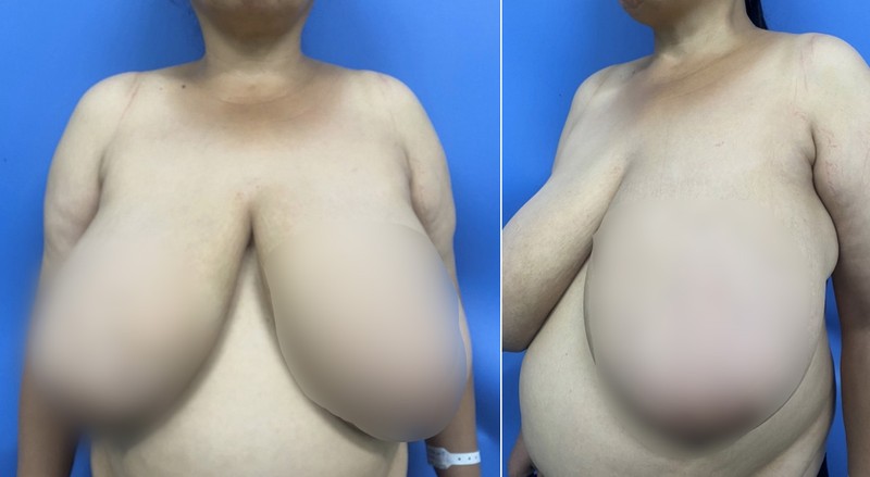 Cặp vú khổng lồ của bệnh nhân (Ảnh: BVCC)