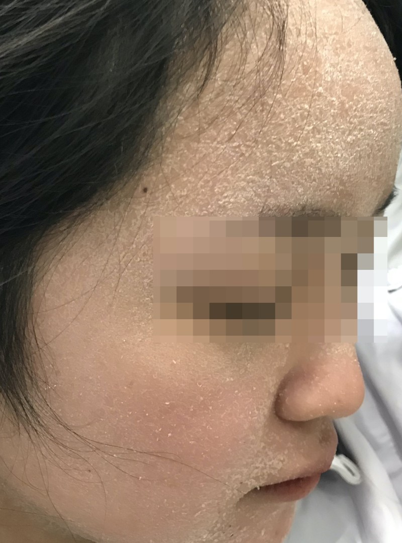 Một bệnh nhân da bị bong tróc đến khám tại Bệnh viện Da liễu Trung ương (Ảnh: BVCC)