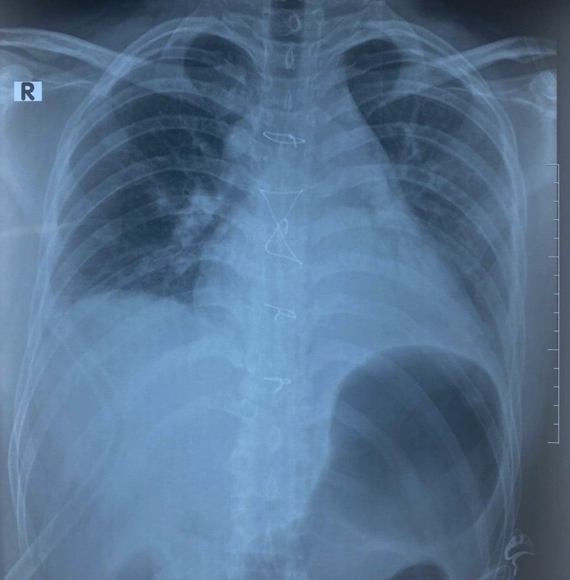 Ảnh chụp X-quang của bệnh nhân (Ảnh: BVCC)